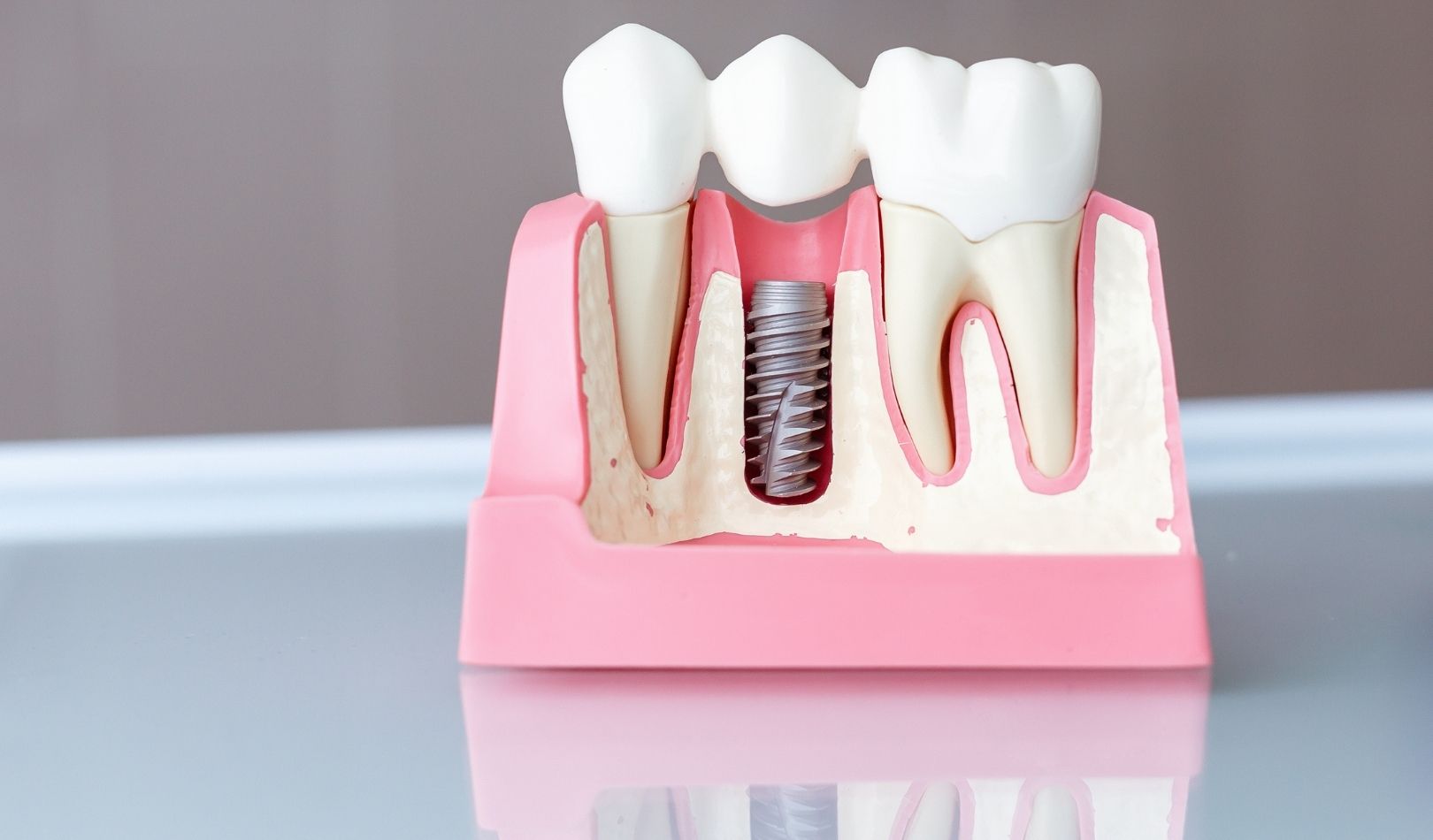 Do certain medical conditions impact eligibility for dental implants?

