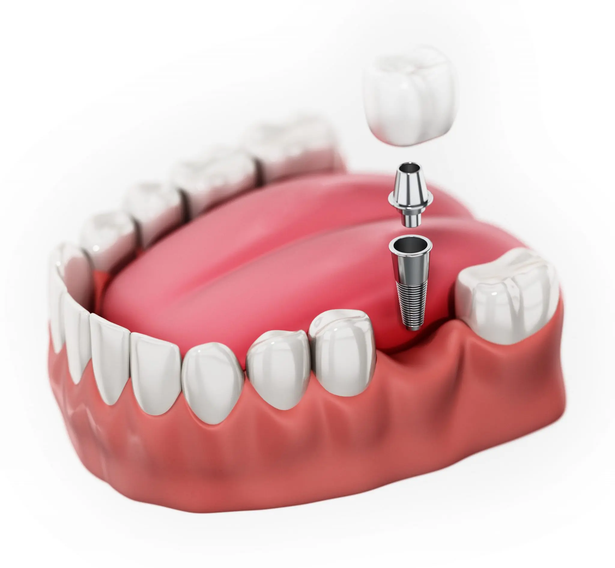 Do Certain Medical Conditions Impact Eligibility For Dental Implants, medical conditions